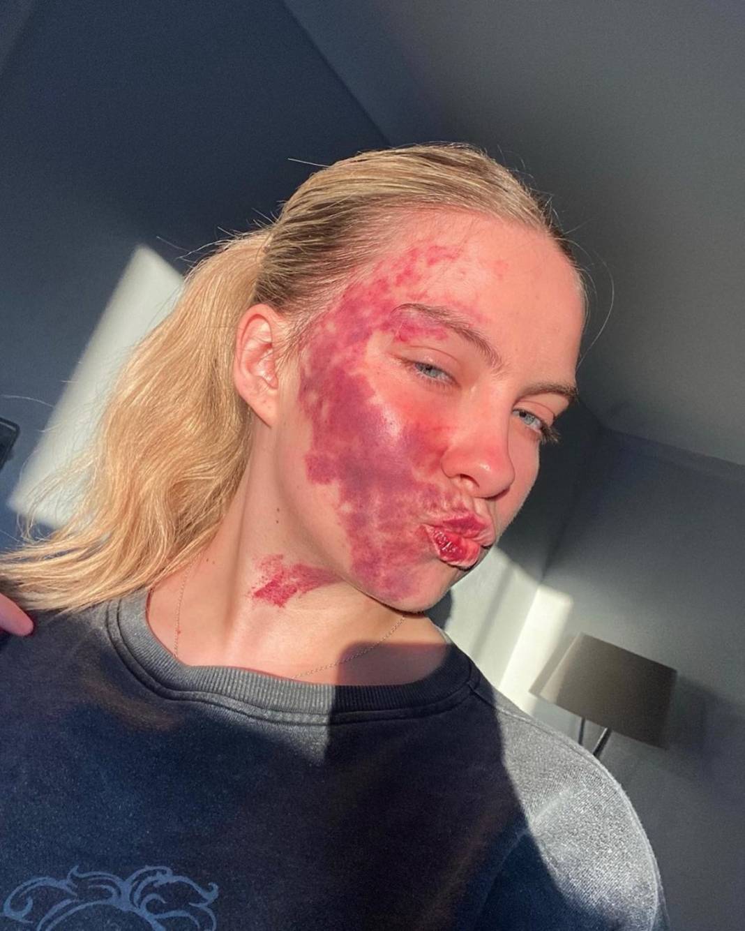 Basit bir uçuk zannetti, korkunç hastalığa yakalandı! Doktorlar bile teşhis koyamadı 3